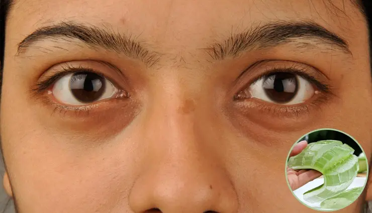 كيفية استخدام جل الصبار لإزالة الهالات السوداء تحت العين بسرعة 